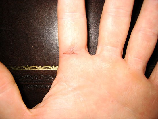 industrial injury