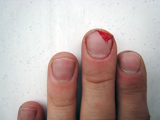 self inflicted injury #733