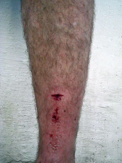 self inflicted injury #733